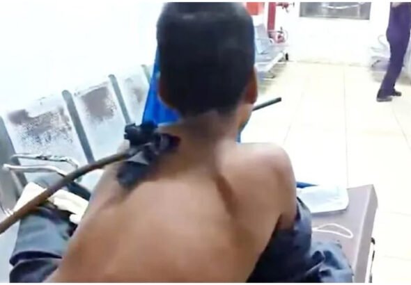 Surat Boy Iron Rod Surgery