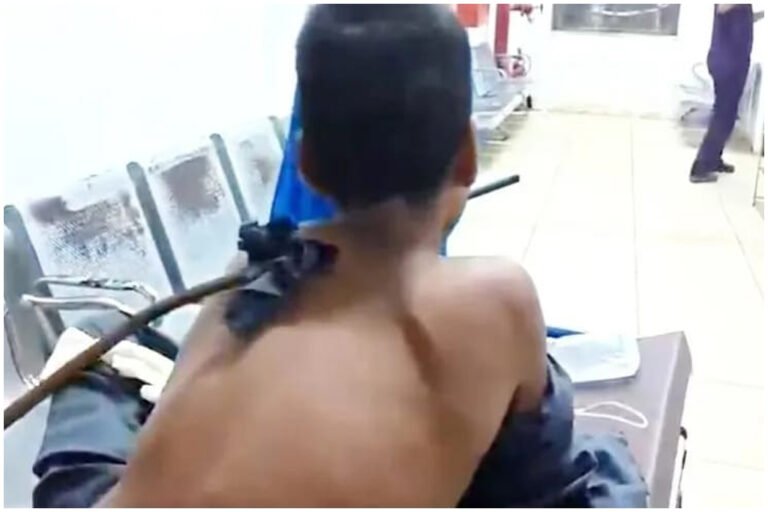 Surat Boy Iron Rod Surgery