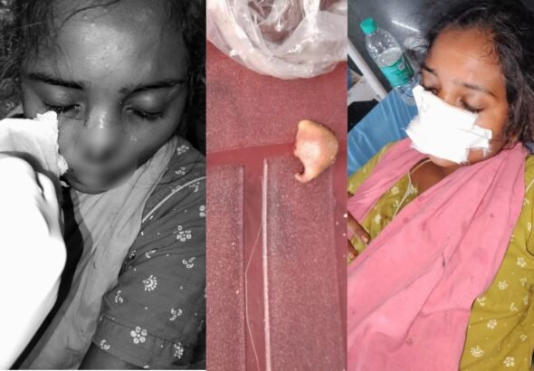 Husband Bites Wife Nose