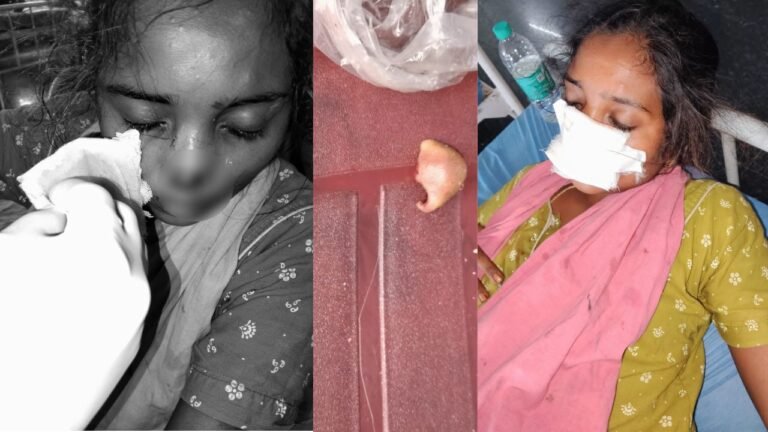 Husband Bites Wife Nose