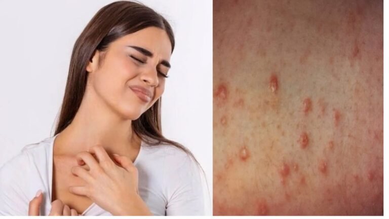 Eczema Symptoms