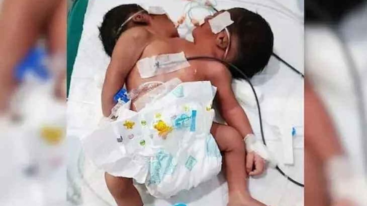 Two-Headed Baby Born in Odisha